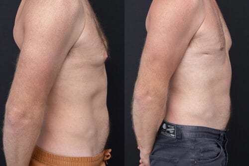 Yezdi Male Chest Reduction - Before and After Image Right Side