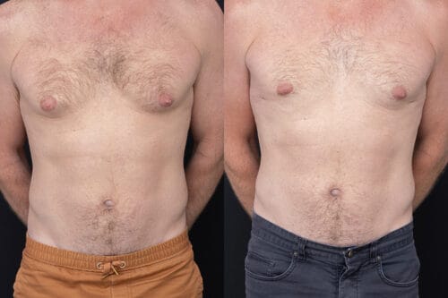 Yezdi Male Chest Reduction - Before and After Photos#2