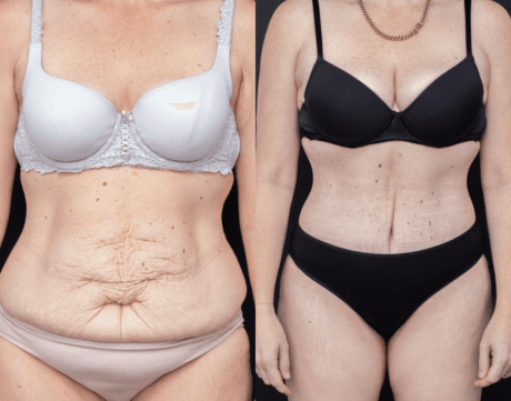 Abdominoplasty