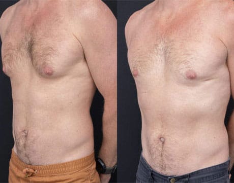 Yezdi-Male-Chest-Reduction-3-460x361
