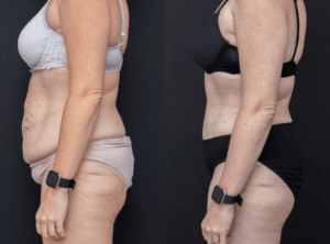 Abdominoplasty