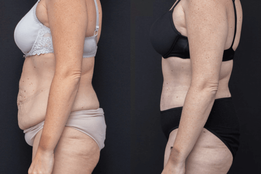 Abdominoplasty and 360 Degree Liposuction