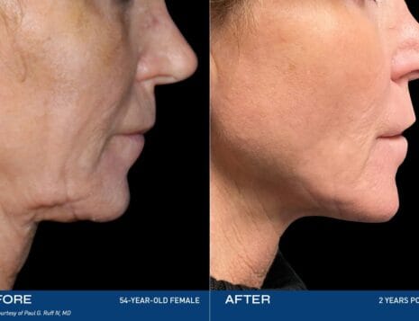 Renuvion: Advanced Technology for Precision in Body Contouring