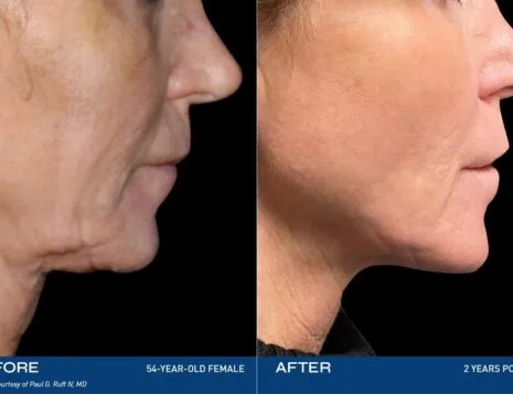 Renuvion: Advanced Technology for Precision in Body Contouring