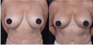 Breast Reduction