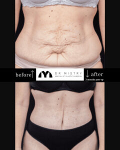 Abdominoplasty Front 3 weeks post-op