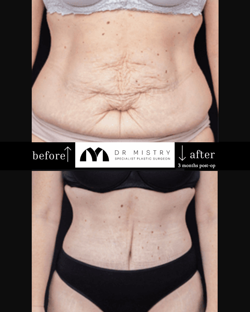 Yezdi Male Chest Reduction #2