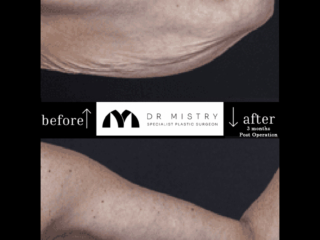 Arm Lift Brachioplasty 3 Months Post Operation