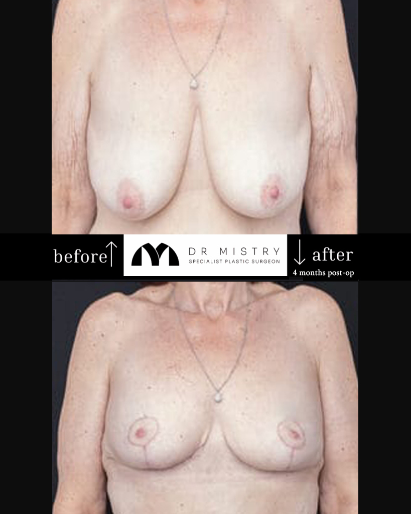 Breast Reduction Patient