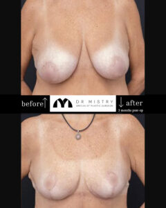 Breast reduction front 3 months post-op