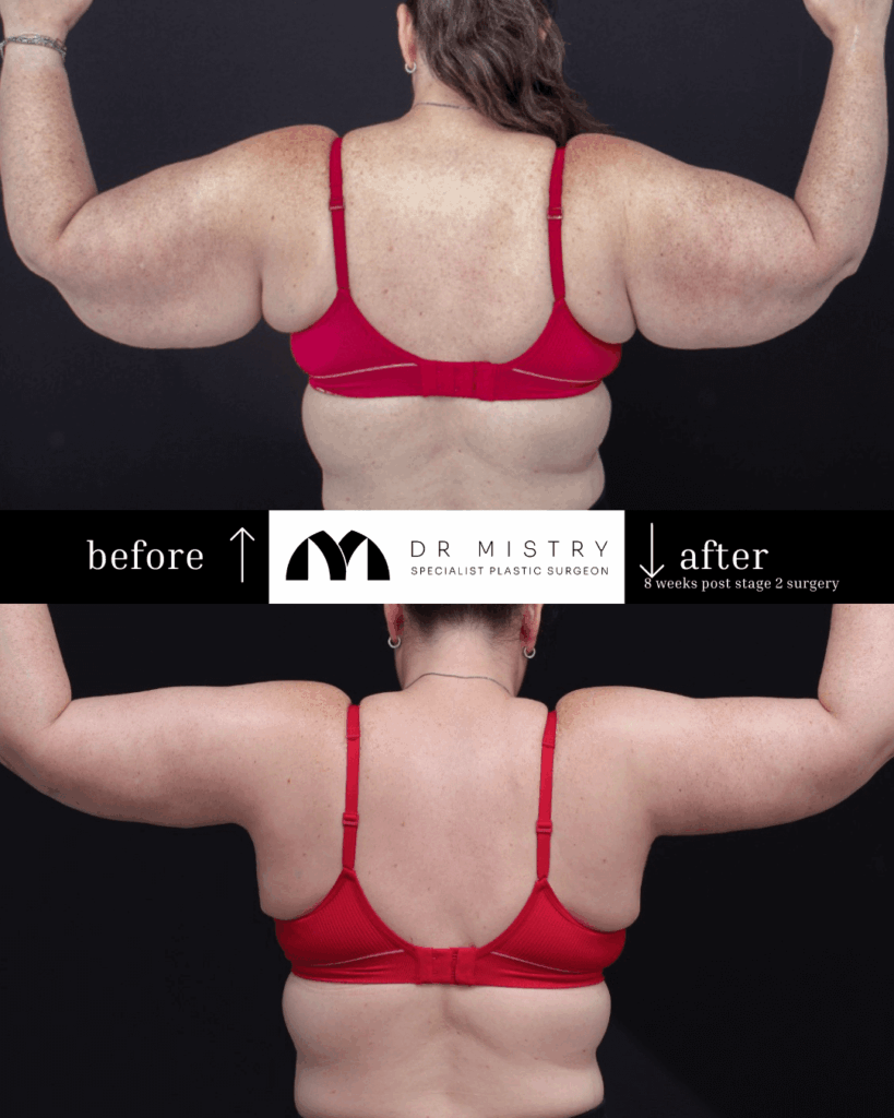 Dr MIstry Brachioplasty BACK (1)