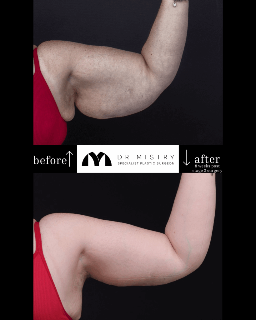 Dr Mistry Brachioplasty - LEFT ARM (1)