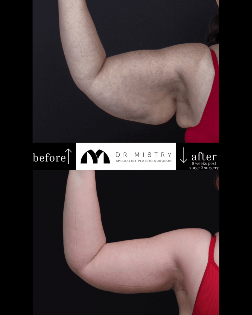 Dr Mistry - Brachioplasty RIGHT ARM (1)