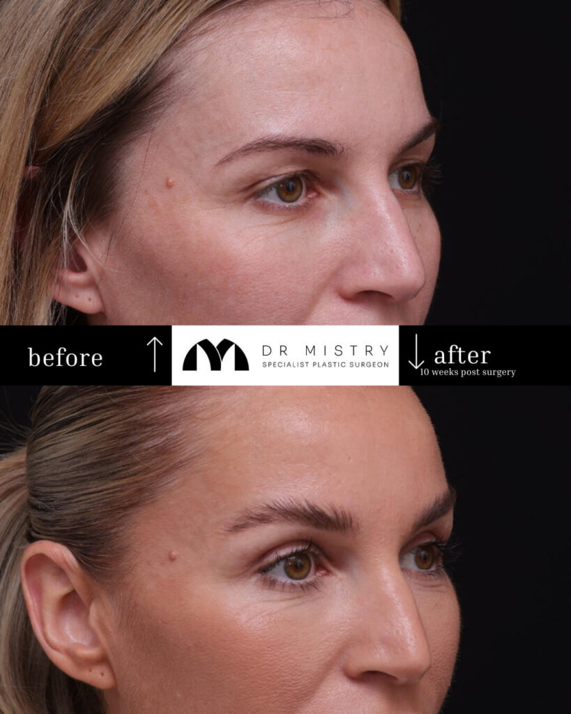 Right Oblique Blepharoplasty 10 weeks post surgery