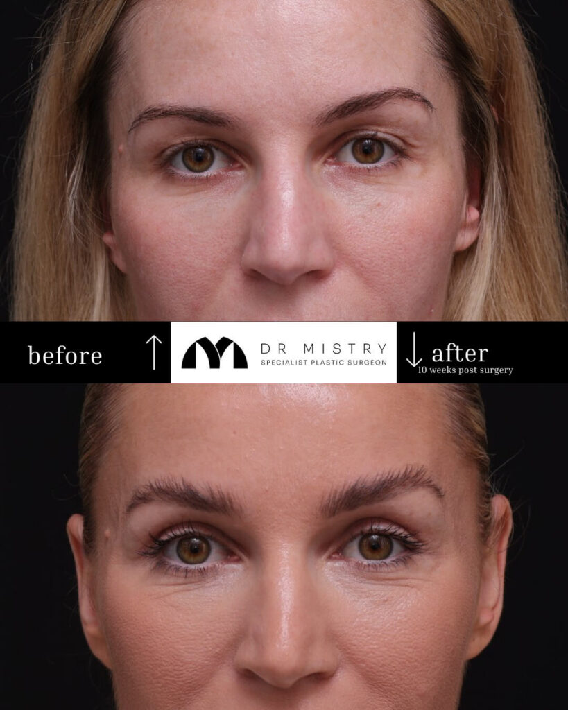 blepharoplasty side 10 weeks post surgery