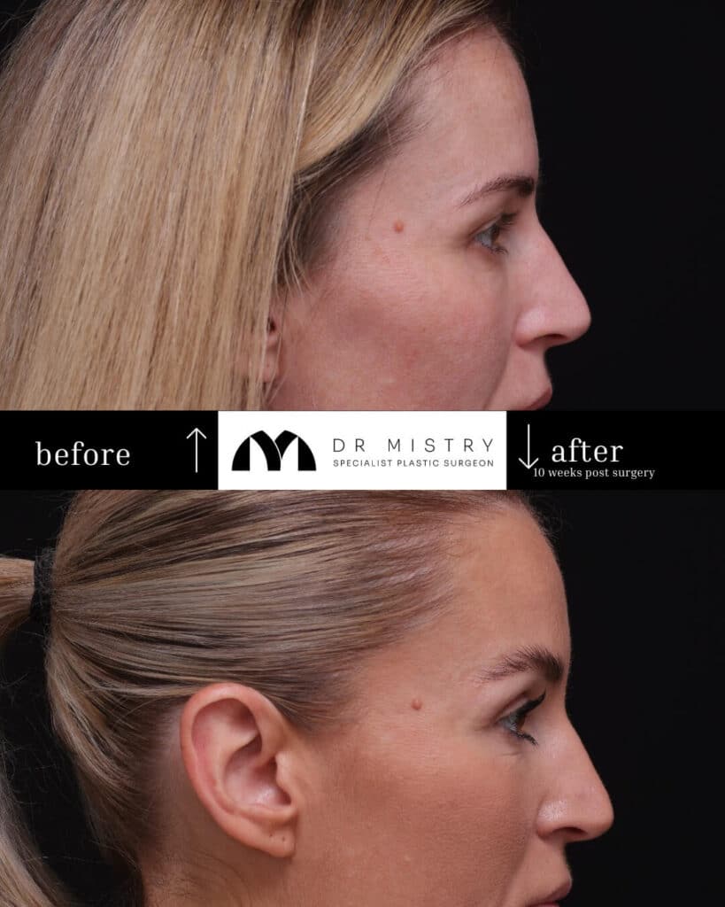 blepharoplasty side 10 weeks post surgery