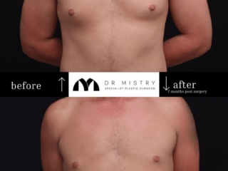 Front Side Post op photos taken 7 months post surgery, 30 year old male