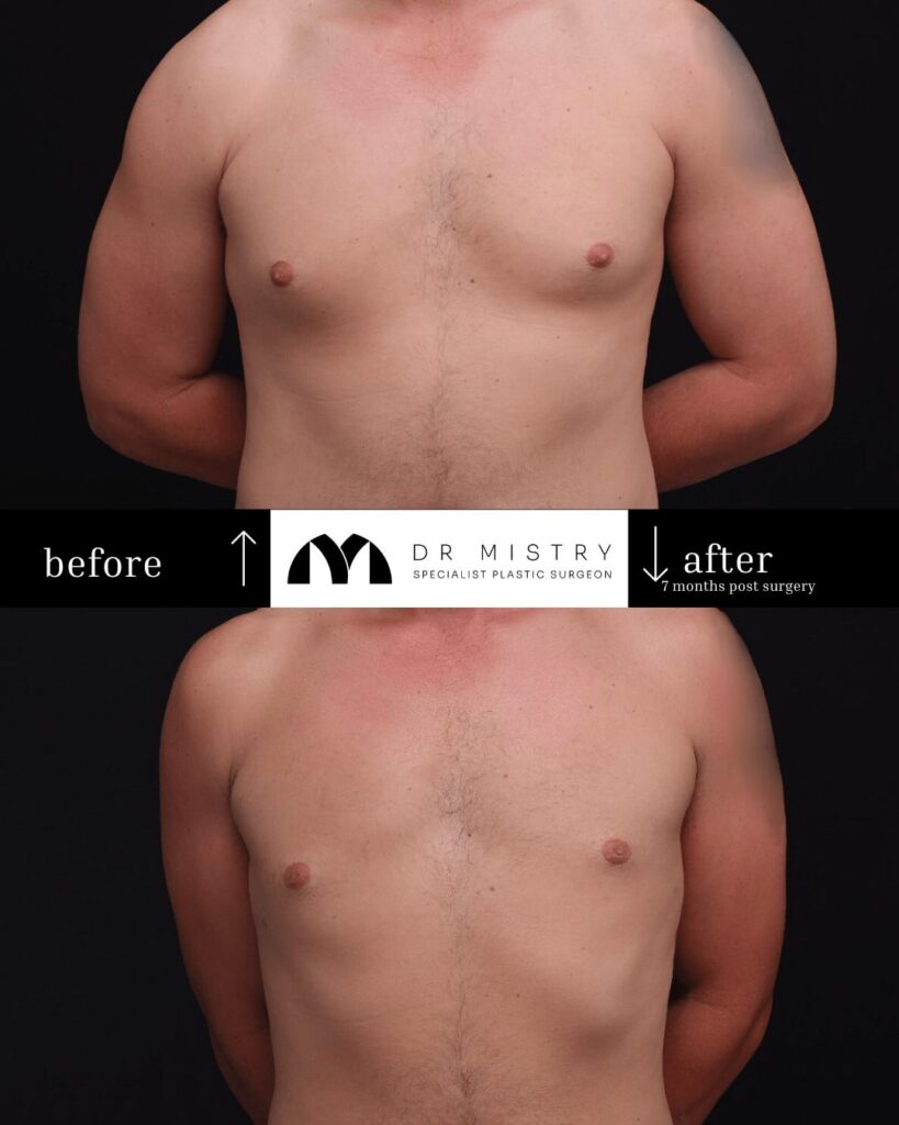 Front Side Post op photos taken 7 months post surgery, 30 year old male