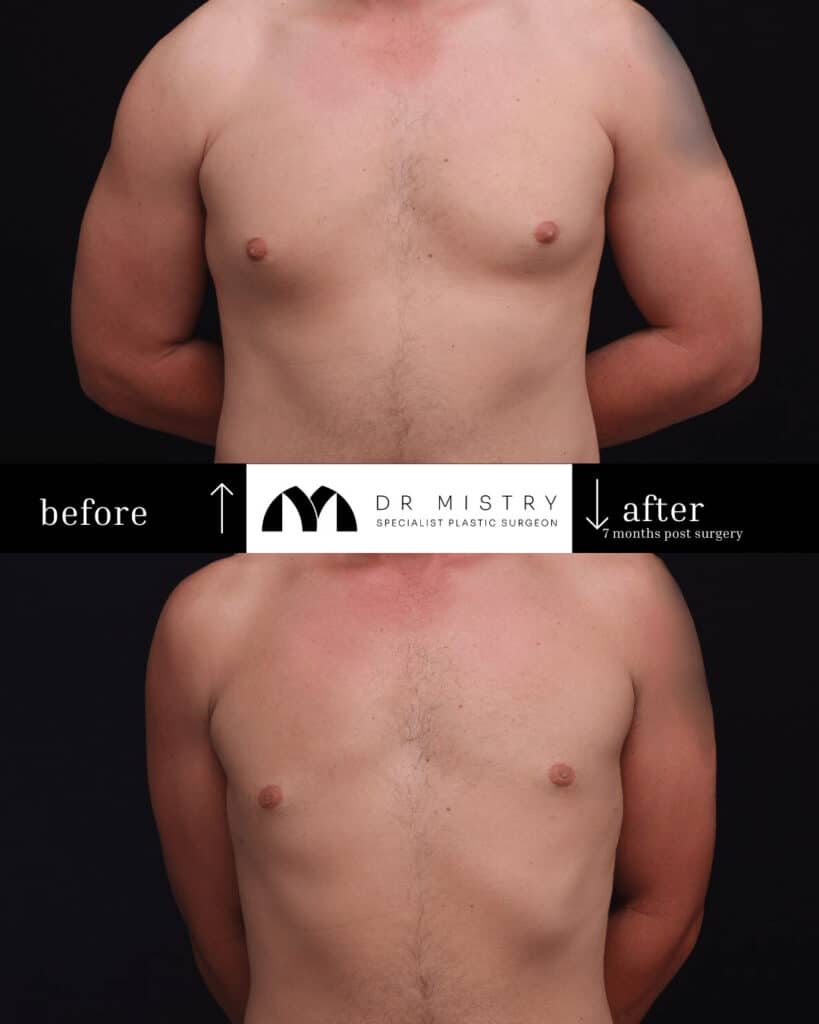 Front Post op photos taken 7 months post surgery, 30 year old male