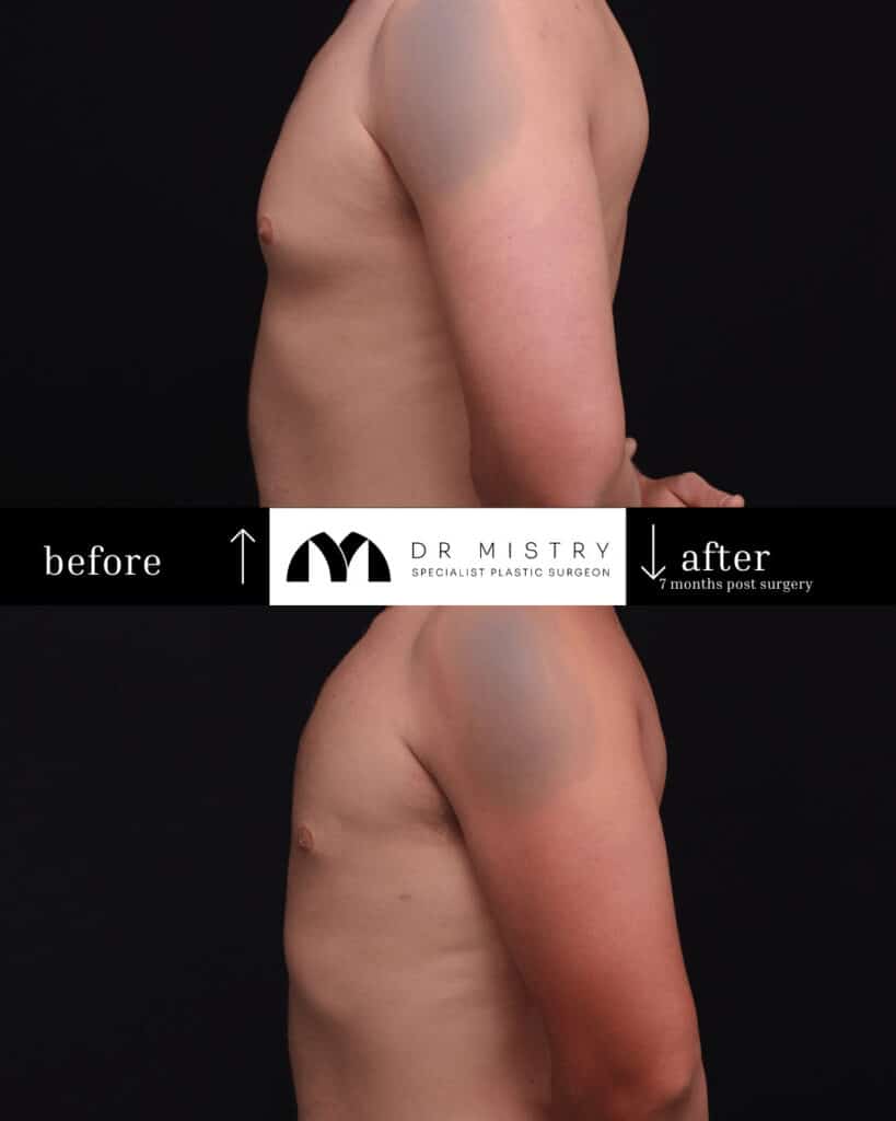 Side Post op photos taken 7 months post surgery, 30 year old male