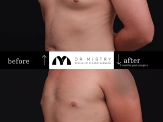 OBLIQUE Post op photos taken 7 months post surgery, 30 year old male