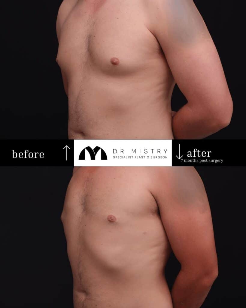 OBLIQUE Post op photos taken 7 months post surgery, 30 year old male