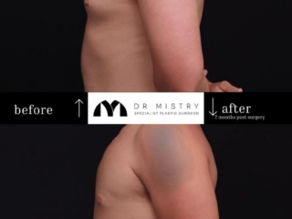 Left Side Post op photos taken 7 months post surgery, 30 year old male