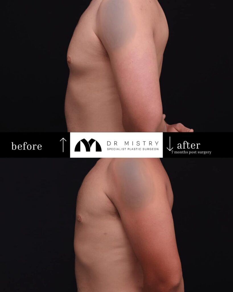 Left Side Post op photos taken 7 months post surgery, 30 year old male