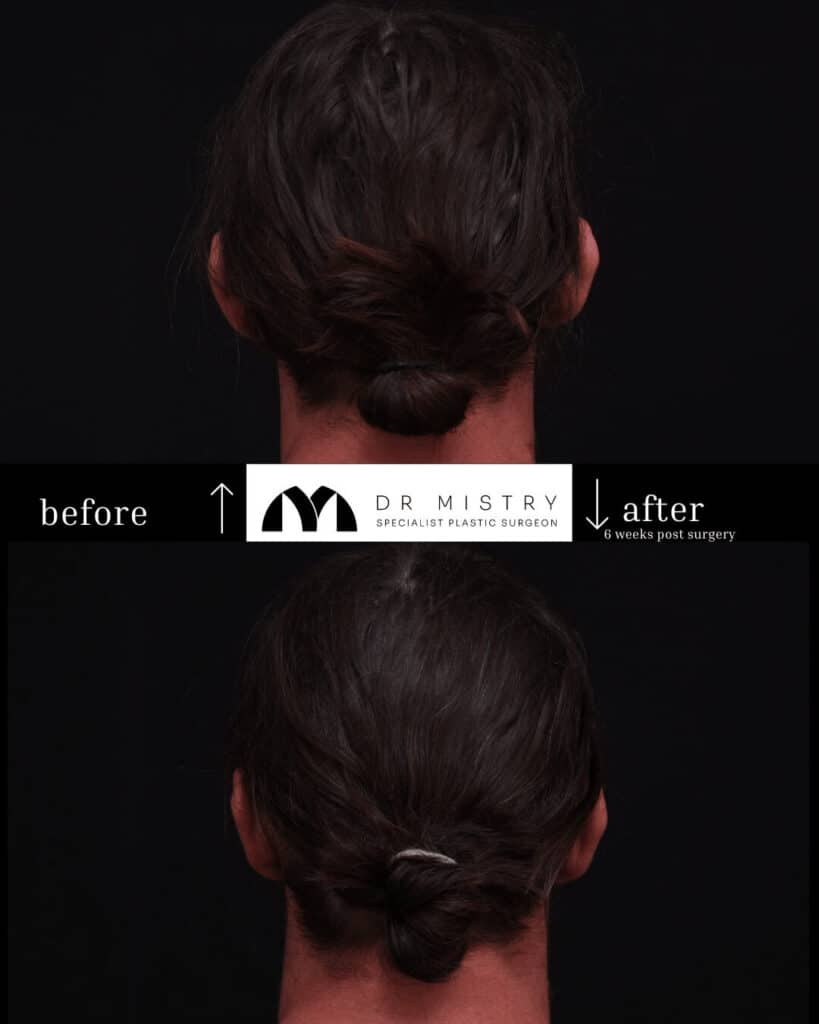 Back Bilateral Otoplasty 6 Weeks Post Surgery.