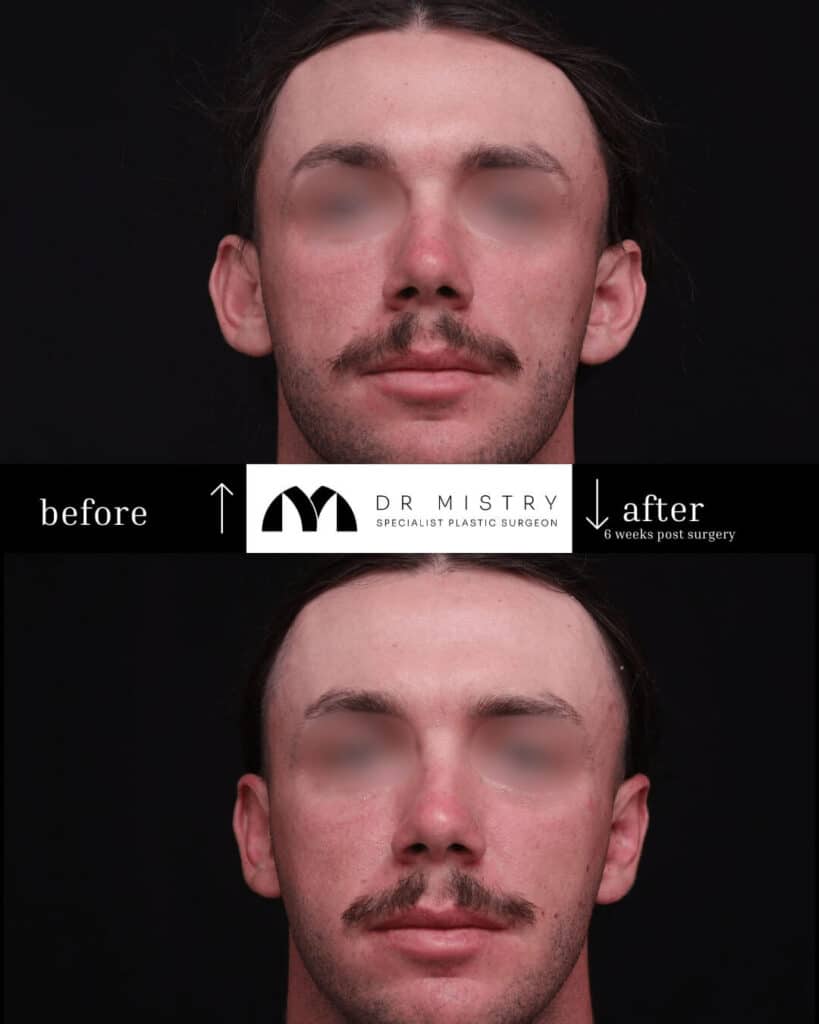 Front Bilateral Otoplasty 6 Weeks Post Surgery.