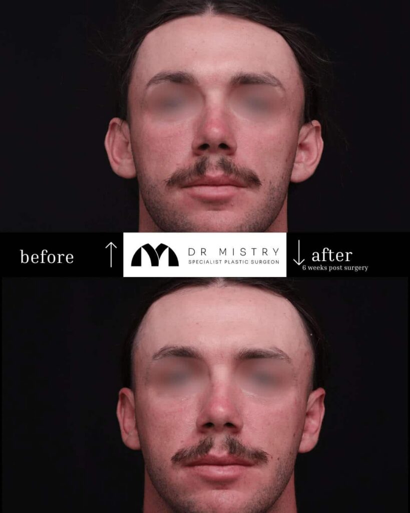 Front Bilateral Otoplasty 6 Weeks Post Surgery.