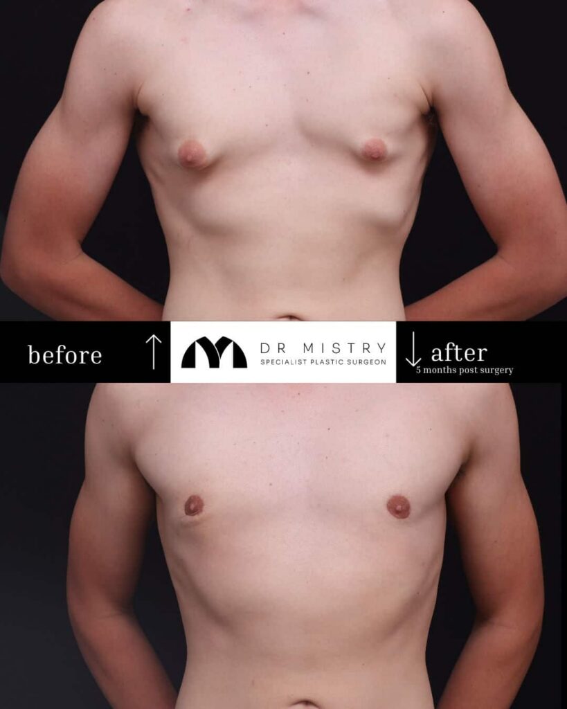 Front Side 5 Months Post Surgery 17yr Old Male Who Underwent Bilateral&nbsp;Gynaecomastia Correction.