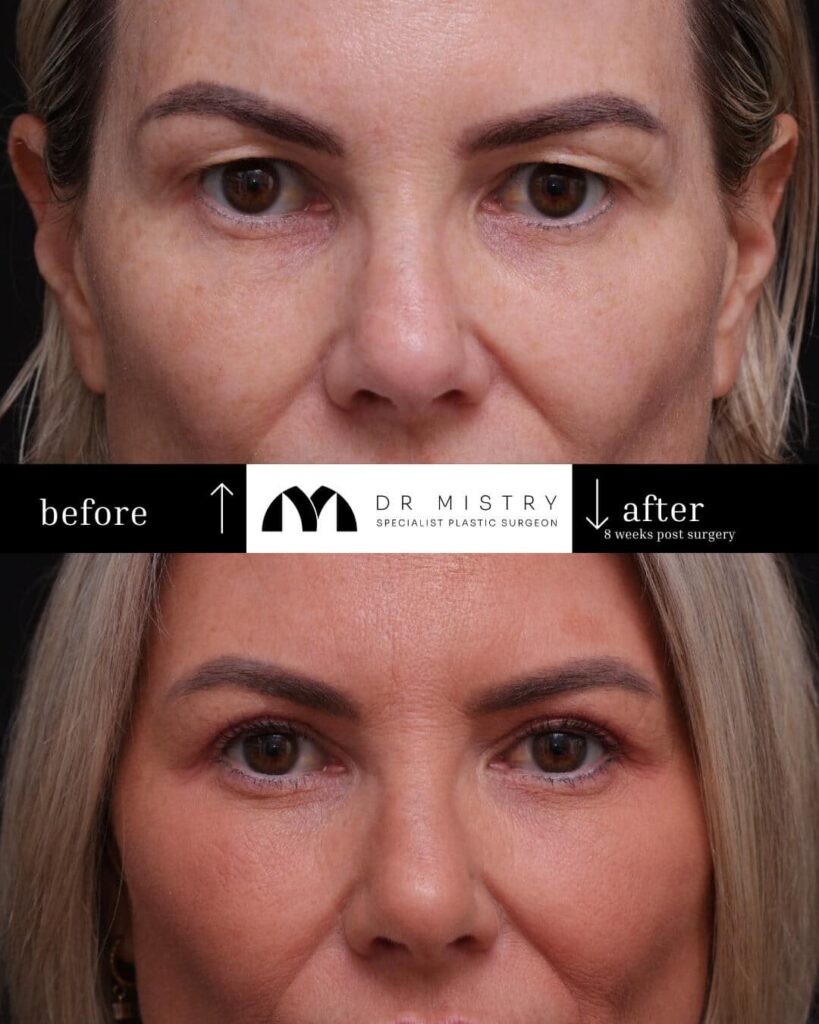 Front Side Blepharoplasty 8 Weeks Post Surgery