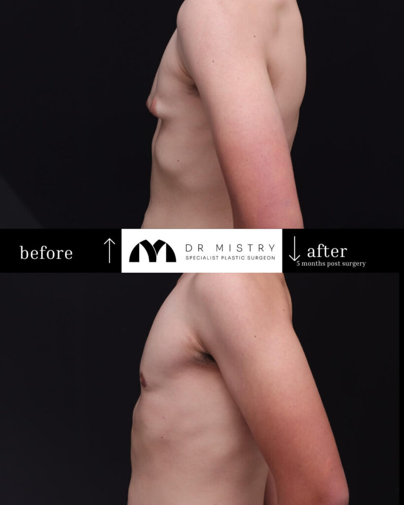 Left Side 5 Months Post Surgery 17yr Old Male Who Underwent Bilateral&nbsp;Gynaecomastia Correction.