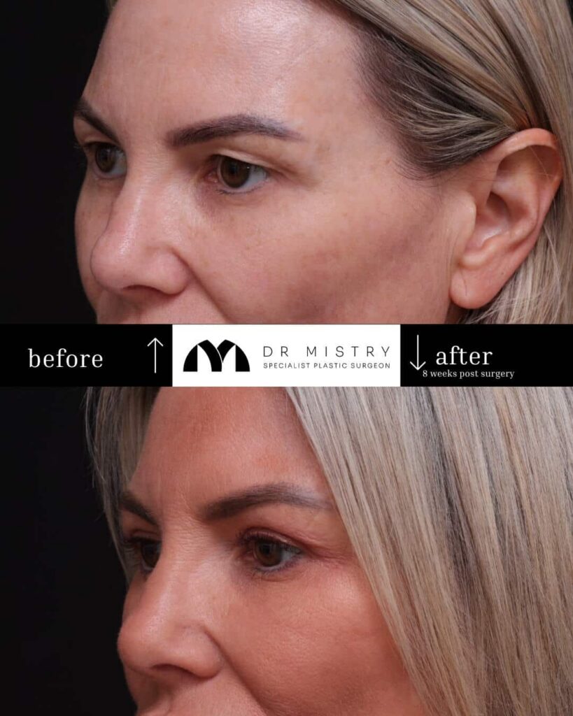 Left Side Oblique Blepharoplasty 8 Weeks Post Surgery