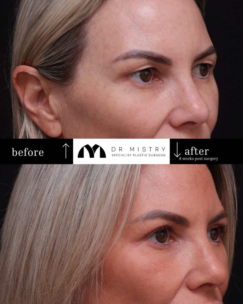 Right Side Blepharoplasty 8 Weeks Post Surgery