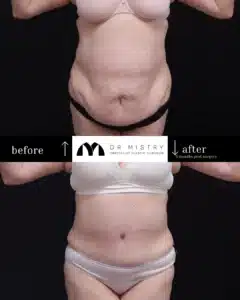 Front side extended abdominoplasty patient 2