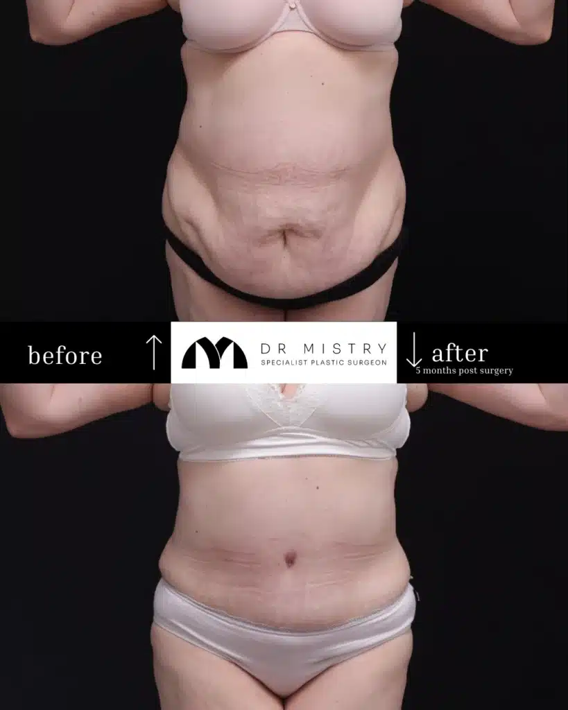 Front Side Extended Liposuction Abdominoplasty Patient 2