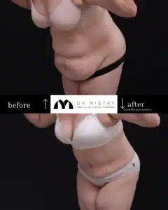 Left obique Extenedn liposuction abdominoplasty patient 2