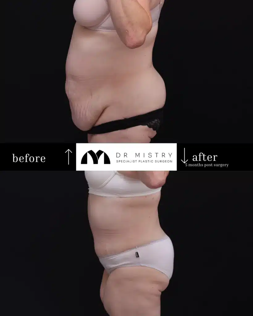 Left Side Extended Liposuction Abdominoplasty Patient 2