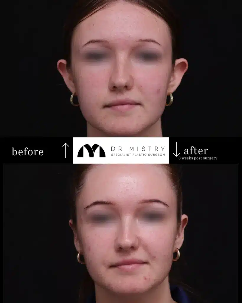 Front post-op photo of a female otoplasty patient at 8 weeks.