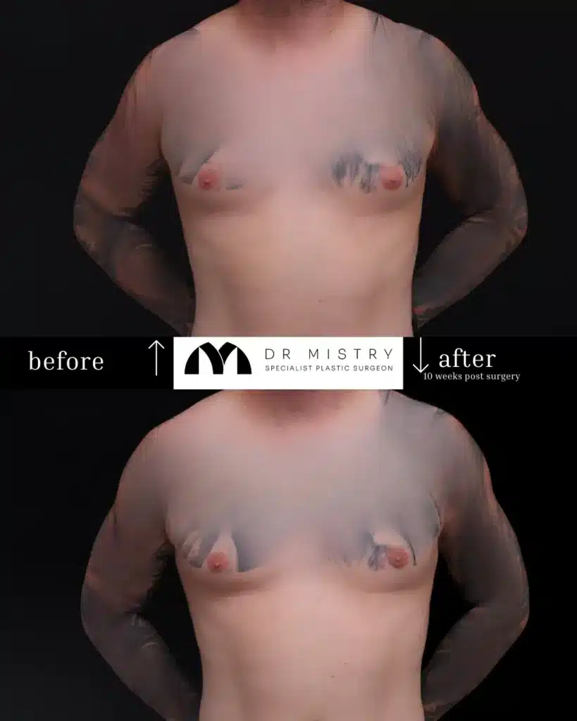 Front Side 10 weeks post surgery 31yr old male who underwent Unilateral Gynaecomastia Correction (Left Chest)
