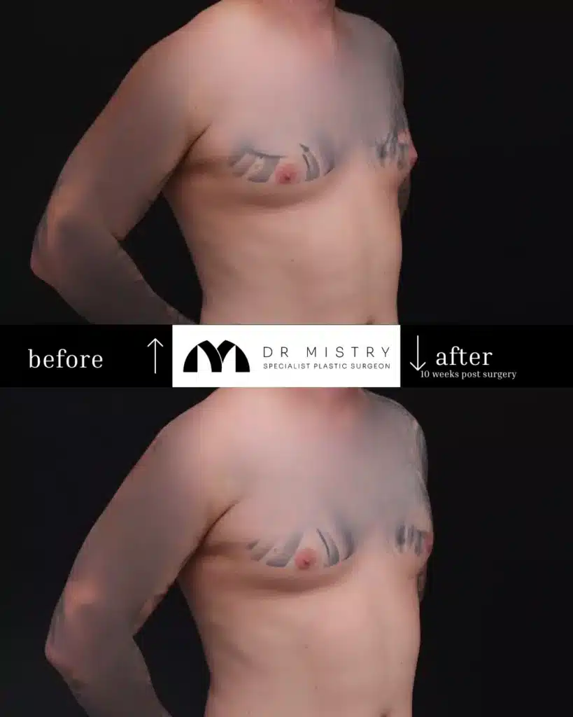Right Oblique 10 weeks post surgery 31yr old male who underwent Unilateral Gynaecomastia Correction (Left Chest)