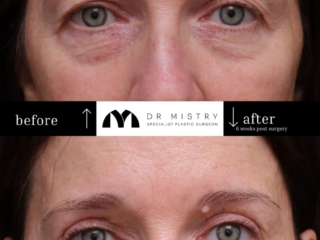 Front view of 54-year-old patient 6 weeks after upper eyelid blepharoplasty