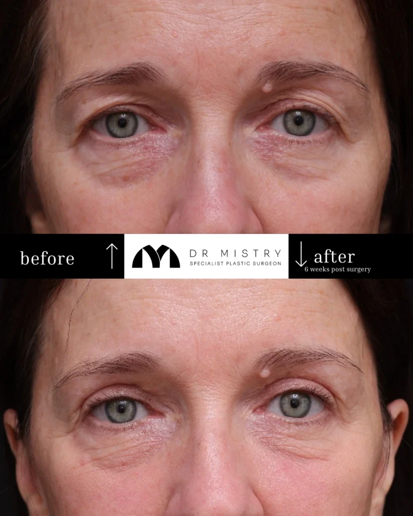 Front view of 54-year-old patient 6 weeks after upper eyelid blepharoplasty