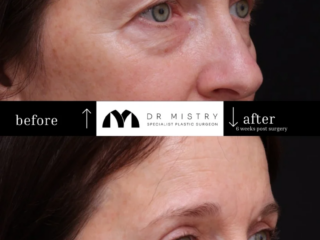 Right 45-degree view of 54-year-old patient 6 weeks after upper eyelid blepharoplasty