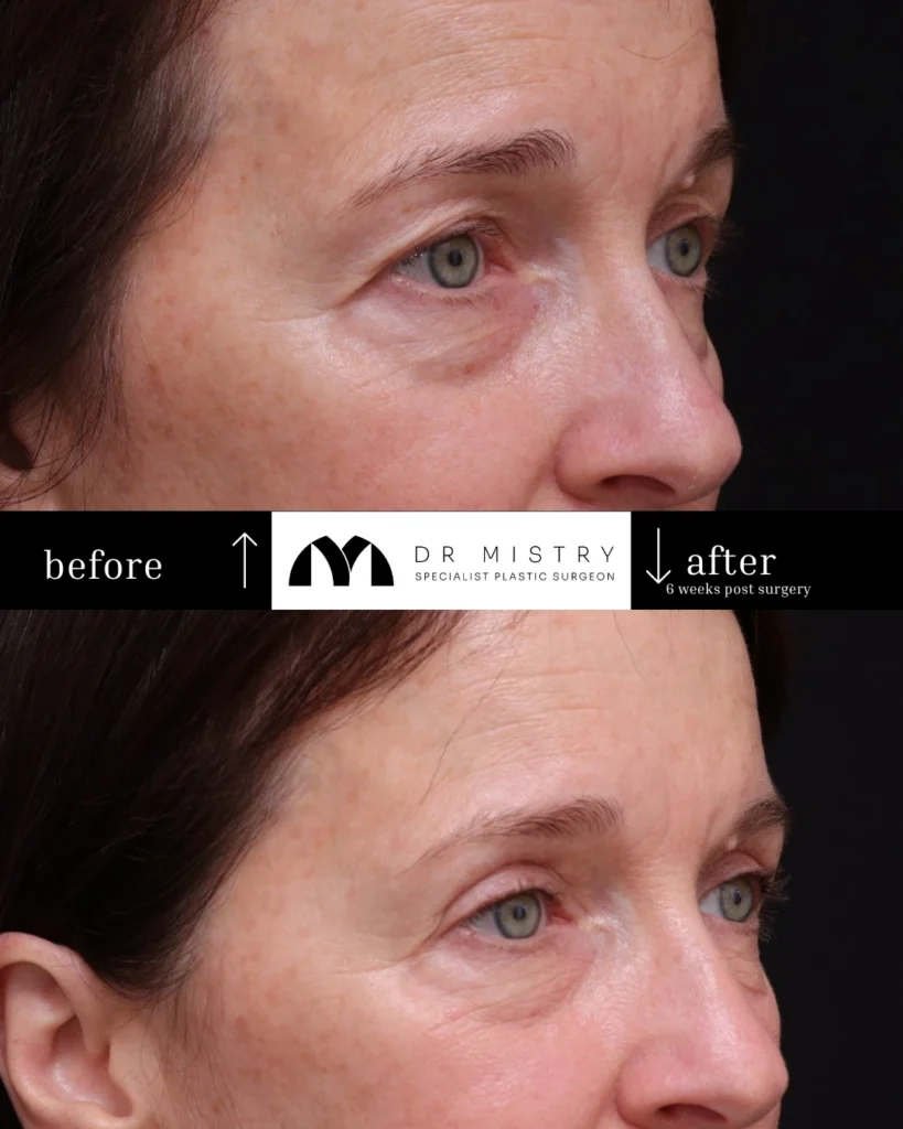 Right 45-degree view of 54-year-old patient 6 weeks after upper eyelid blepharoplasty